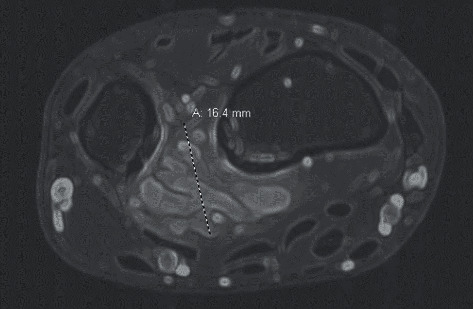 Case Report of Fibro-Adipose Vascular Anomaly (FAVA) with Activating Somatic <i>PIK3CA</i> Mutation.