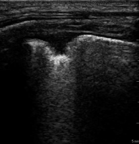 Retrospective analysis of the diagnostic accuracy of lung ultrasound for pulmonary embolism in patients with and without pleuritic chest pain.