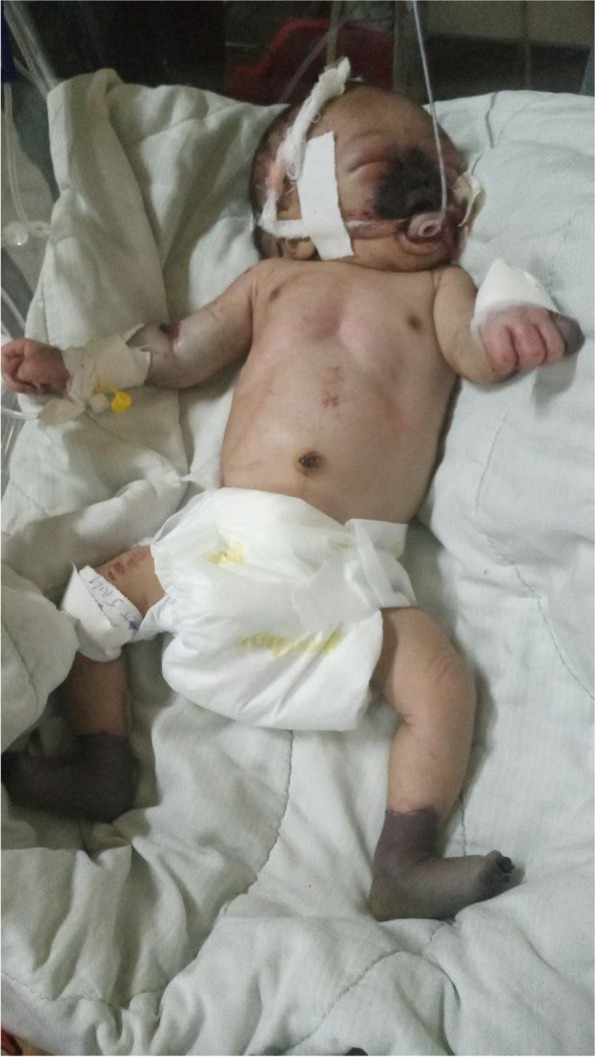 Nasolabial and distal limbs dry gangrene in newborn due to hypernatremic dehydration with disseminated intravascular coagulation: a case report.