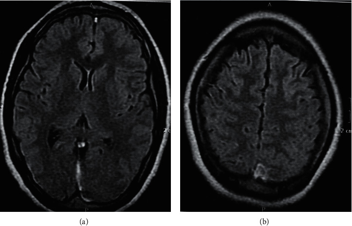 Primary Cerebral Venous Thrombosis in a Patient with Immune Thrombocytopenic Purpura.