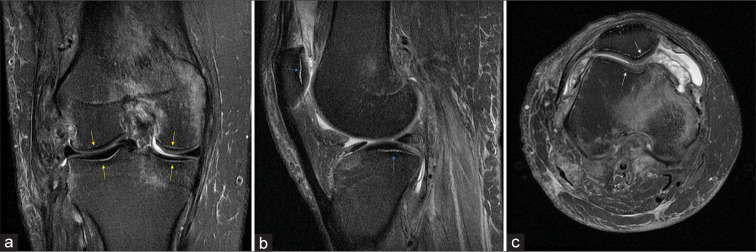 Hawkins sign of the knee: Imaging appearance and clinical implication of an unusual pattern of disuse osteopenia.
