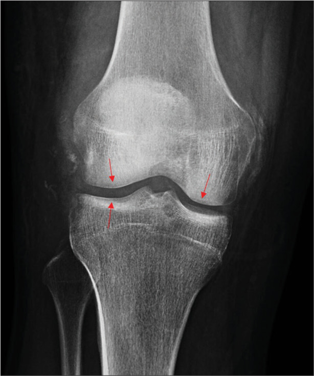 Hawkins sign of the knee: Imaging appearance and clinical implication of an unusual pattern of disuse osteopenia.