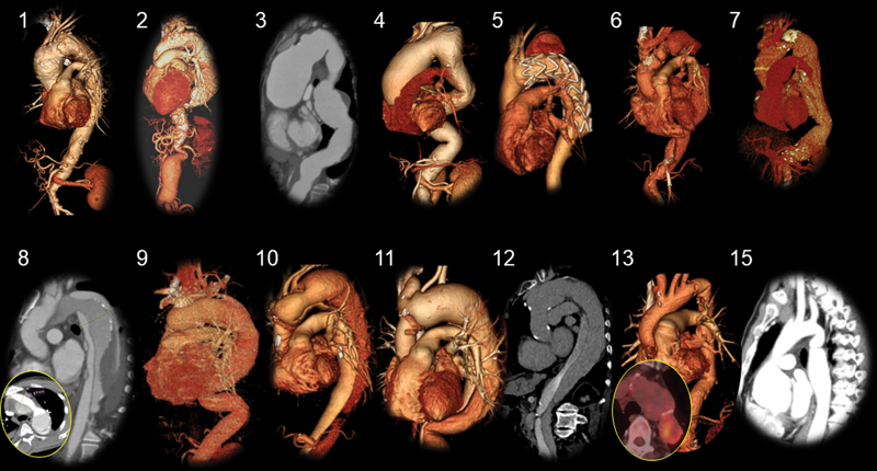 Transsternal and Transpericardial Approach to Descending Thoracic Aorta via Median Sternotomy-An Option for Extensive Aortic Surgery.