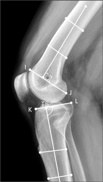 Anatomical bone structure differences in patients with hemophilic arthropathy of the knee.