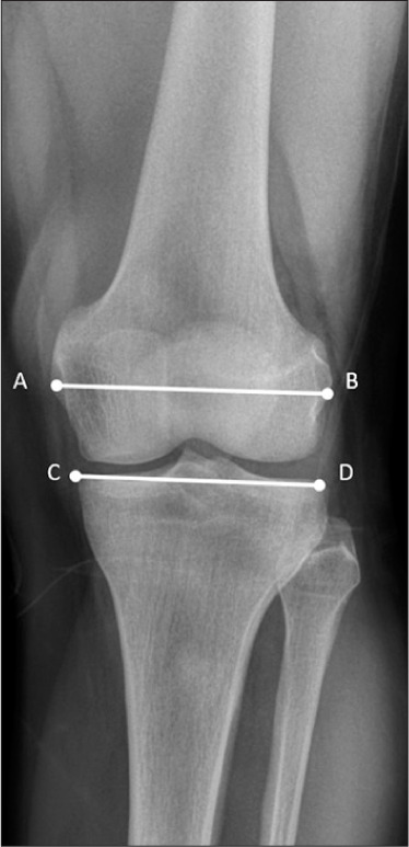 Anatomical bone structure differences in patients with hemophilic arthropathy of the knee.