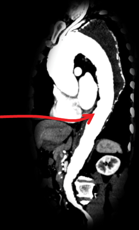 Transsternal and Transpericardial Approach to Descending Thoracic Aorta via Median Sternotomy-An Option for Extensive Aortic Surgery.