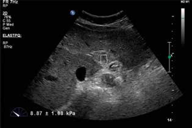 An investigation of the efficacy of shear wave elastography in the characterization of benign and malignant liver lesions.