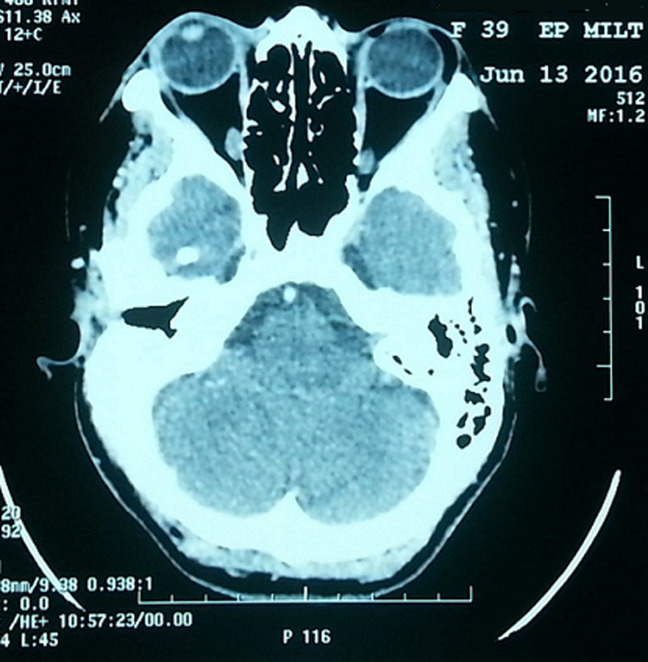[Unusual localizations of subcutaneous lipomas: case report].