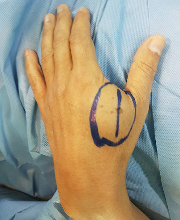 [Unusual localizations of subcutaneous lipomas: case report].