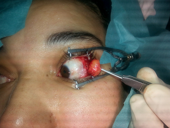 [Unusual localizations of subcutaneous lipomas: case report].
