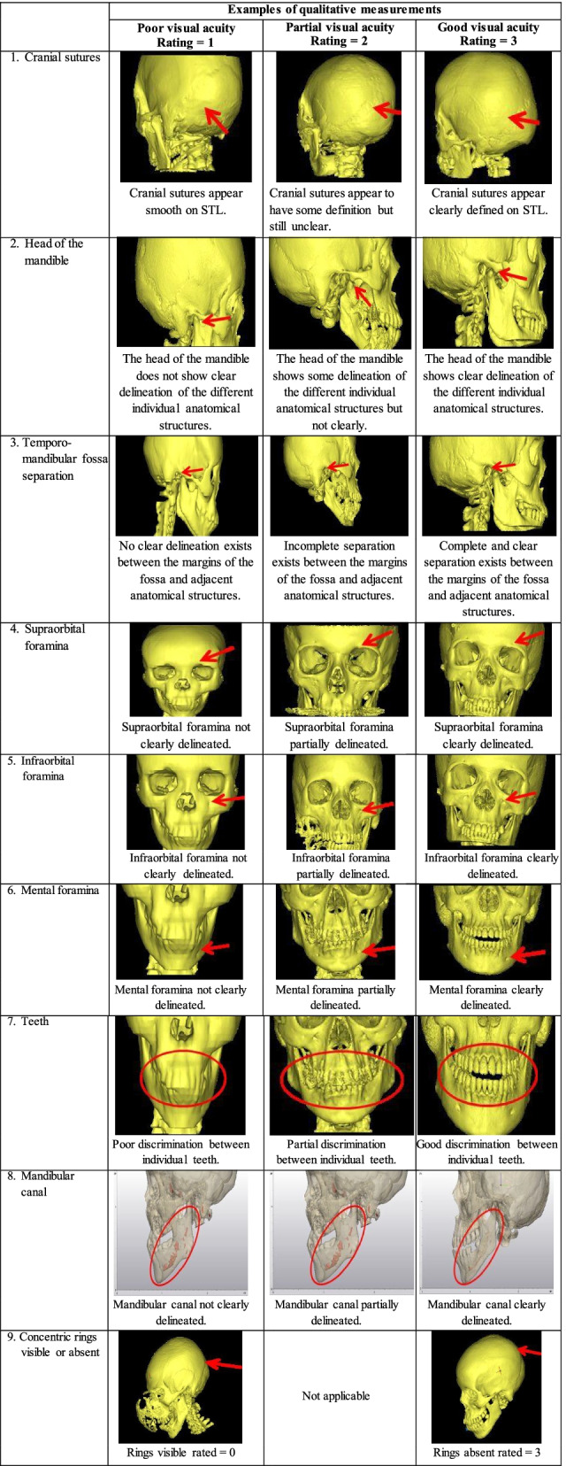 Stereolithography (STL) measurement rubric for the evaluation of craniomaxillofacial STLs.