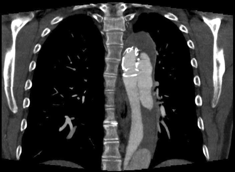 Frozen Elephant Trunk Procedure and Risk for Distal Stent-Graft-Induced New Entries.