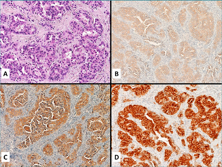 Immunohistochemistry with 3 different clones in anaplastic lymphoma kinase fluorescence in situ hybridization positive non-small-cell lung cancer with thymidylate synthase expression analysis: a multicentre, retrospective, Italian study.