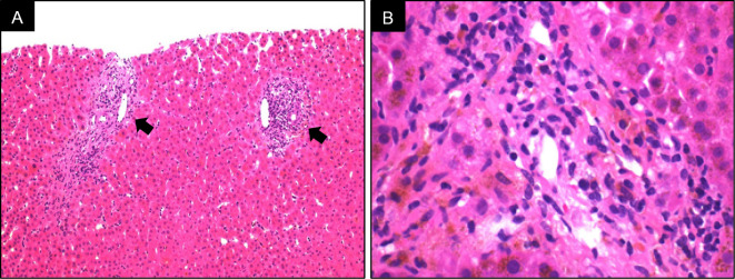Successful treatment of acute pancreatitis associated with late-onset acute liver GVHD after second allogeneic hematopoietic cell transplantation.