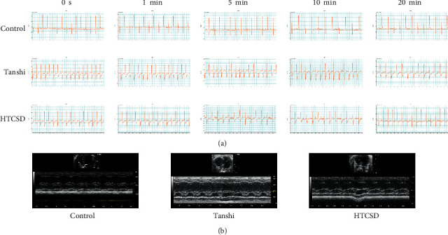 Nontargeted Metabolomic Profiling of Huo-Tan-Chu-Shi Decoction in the Treatment of Coronary Heart Disease with Phlegm-damp Syndrome.