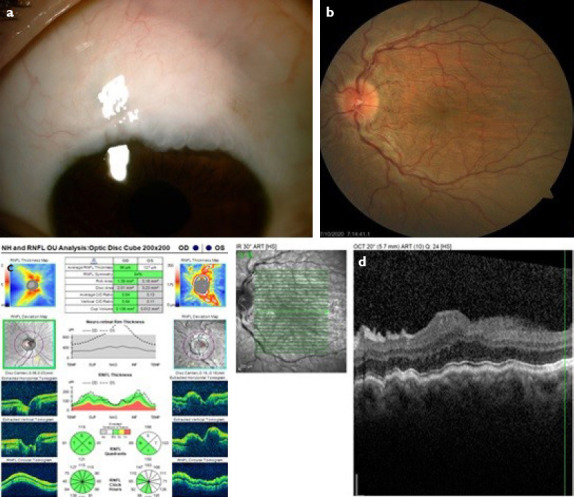 Scleral Flap Wound Dehiscence with Valsalva Maneuver After Trabeculectomy with Mitomycin C.