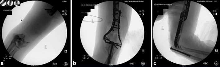 Traumatic Humeral Diaphysis Extrusion and Replantation With Periosteal Involvement.