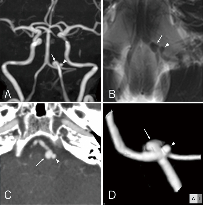 Kissing Aneurysms of the Posterior Inferior Cerebellar Artery Treated by Anchor Coil Technique and Stenting from the Contralateral Side: A Case Report.