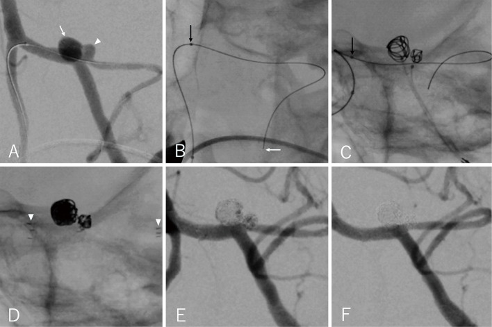 Kissing Aneurysms of the Posterior Inferior Cerebellar Artery Treated by Anchor Coil Technique and Stenting from the Contralateral Side: A Case Report.