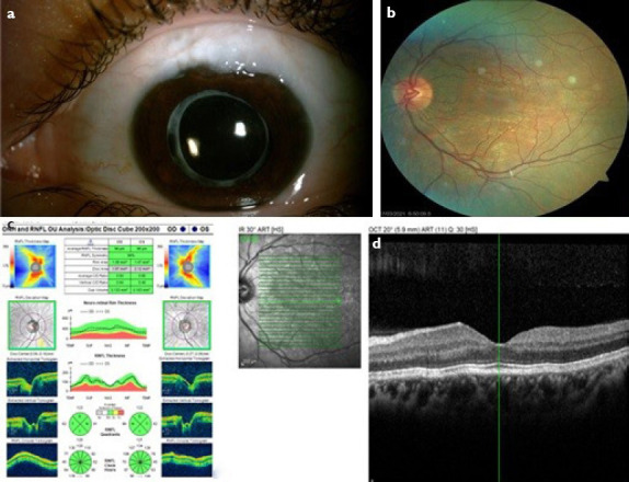 Scleral Flap Wound Dehiscence with Valsalva Maneuver After Trabeculectomy with Mitomycin C.