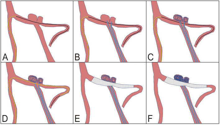 Kissing Aneurysms of the Posterior Inferior Cerebellar Artery Treated by Anchor Coil Technique and Stenting from the Contralateral Side: A Case Report.