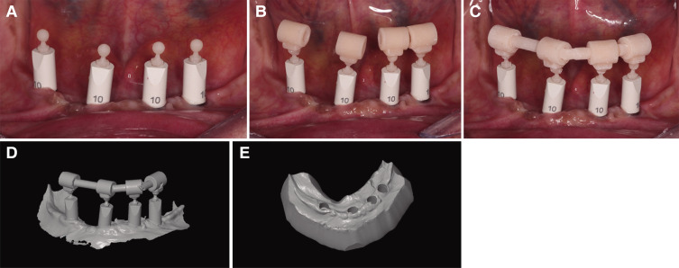 Conventional and digital impressions for complete-arch implant-supported fixed prostheses: time, implant quantity effect and patient satisfaction.