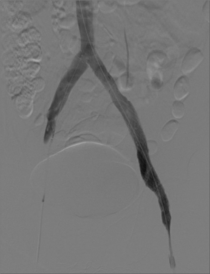 Iliocaval stenting for May-Thurner syndrome: Initial experience.