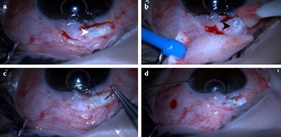 Scleral Flap Wound Dehiscence with Valsalva Maneuver After Trabeculectomy with Mitomycin C.