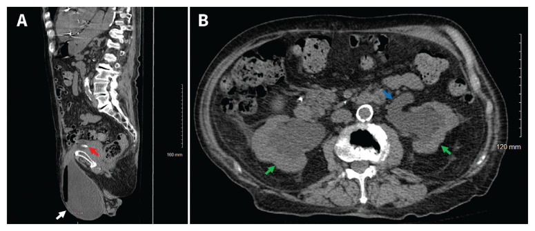 Postrenal acute kidney injury from a sliding inguinal hernia.