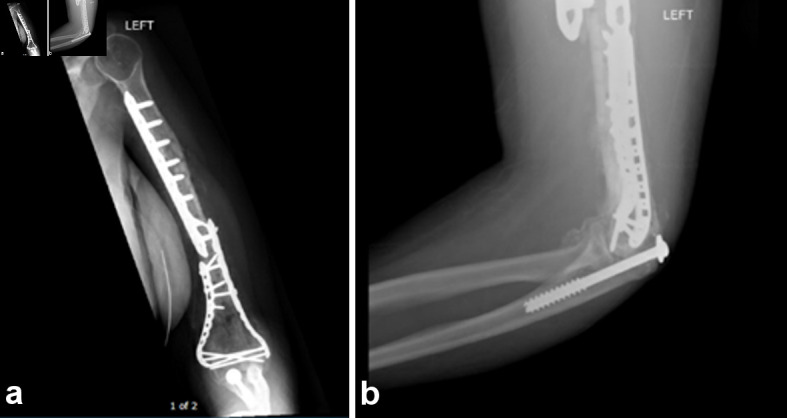 Traumatic Humeral Diaphysis Extrusion and Replantation With Periosteal Involvement.