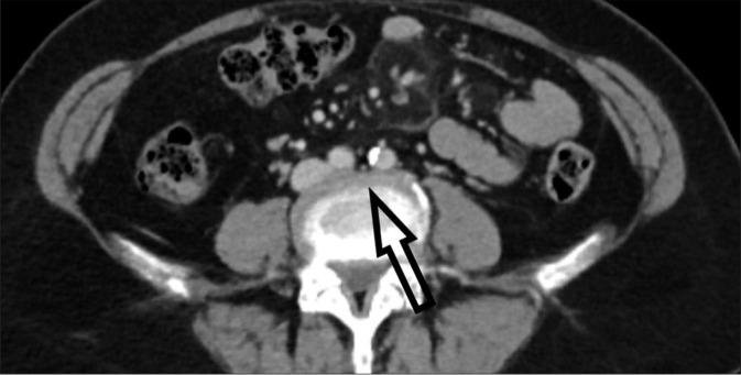 Iliocaval stenting for May-Thurner syndrome: Initial experience.