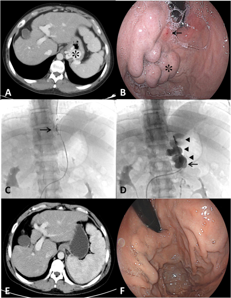 Balloon-occluded retrograde transvenous obliteration with lauromacrogol sclerosant foam for gastric varices