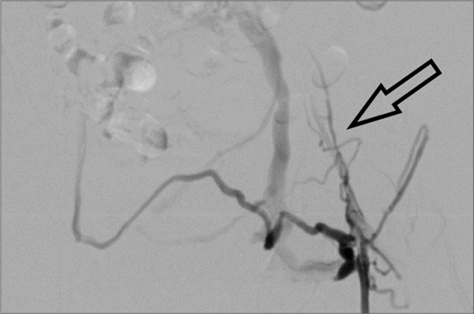 Iliocaval stenting for May-Thurner syndrome: Initial experience.