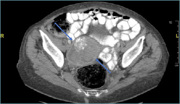 Primary adenosquamous carcinoma of the endometrium with glassy cell features. A diagnostic pitfall as a very rare tumour type in the endometrium.