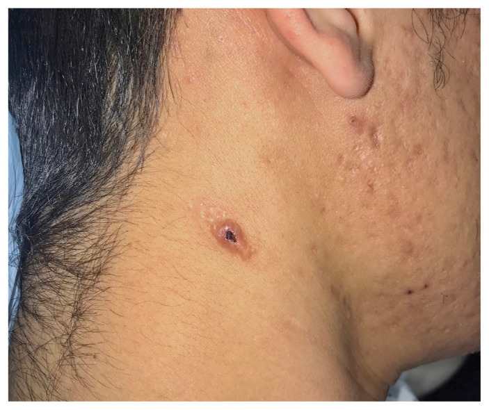 Umbilicated papules in disseminated cryptococcosis.