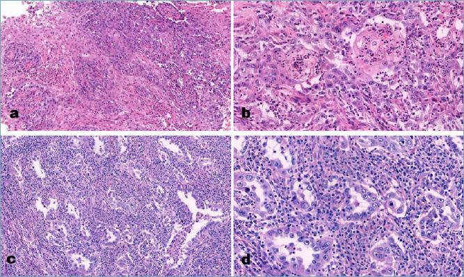 Primary adenosquamous carcinoma of the endometrium with glassy cell features. A diagnostic pitfall as a very rare tumour type in the endometrium.