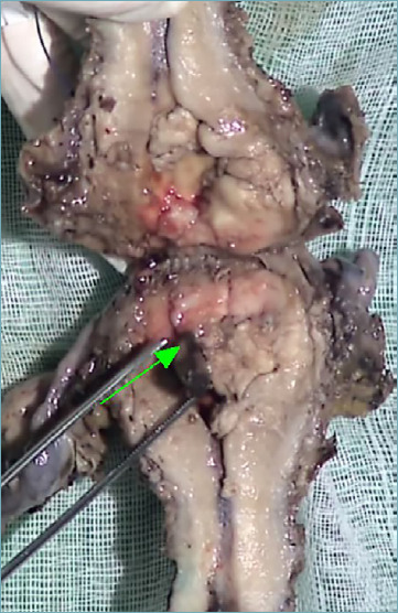 Primary adenosquamous carcinoma of the endometrium with glassy cell features. A diagnostic pitfall as a very rare tumour type in the endometrium.