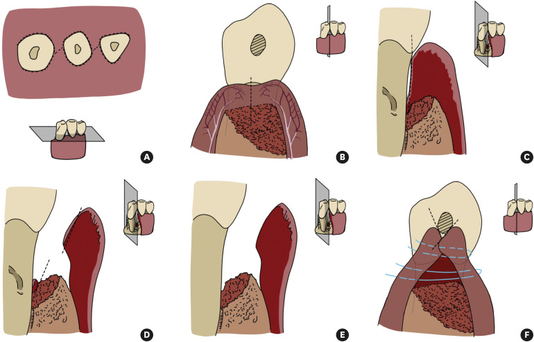 Periodontal granulation tissue preservation in surgical periodontal disease treatment: a pilot prospective cohort study.