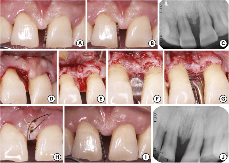 Periodontal granulation tissue preservation in surgical periodontal disease treatment: a pilot prospective cohort study.