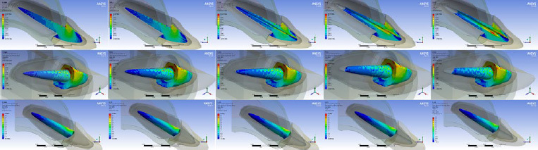 Effect of Light Emission Through an Optical Fiber Device on the Bond Strength of a Hollow Experimental Intraradicular Post.