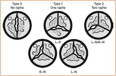Bicuspid Aortic Stenosis with and without Aortopathy: Considerations for Surgical Aortic Valve Replacement versus Transcatheter Aortic Valve Replacement.