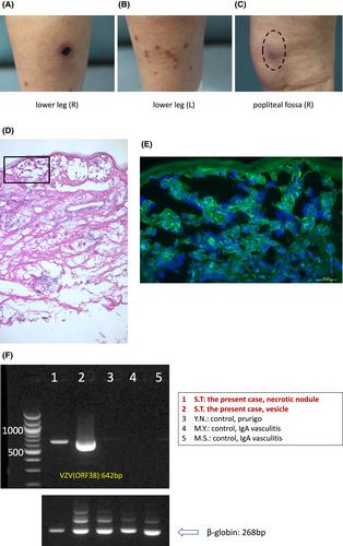 Persistent varicella zoster virus infection following mRNA COVID-19 vaccination was associated with the presence of encoded spike protein in the lesion