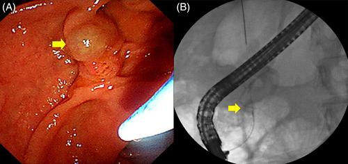 An adult choledochocele case presenting with unexplained biliary colic: Awareness of endoscopic feature is important