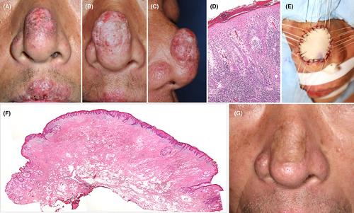 A case of refractory hypertrophic lupus erythematosus on the face whose irreversible skin fibrosis was treated by local full-thickness skin graft under disease control with a combined use of topical and systemic immunosuppressants, and hydroxychloroquine