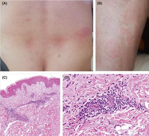 Erythema annulare centrifugum in the setting of COVID-19 infection: A case report and literature review