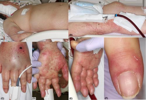 A case of COVID-19 with pernio-like skin lesions and increased red blood cell distribution width