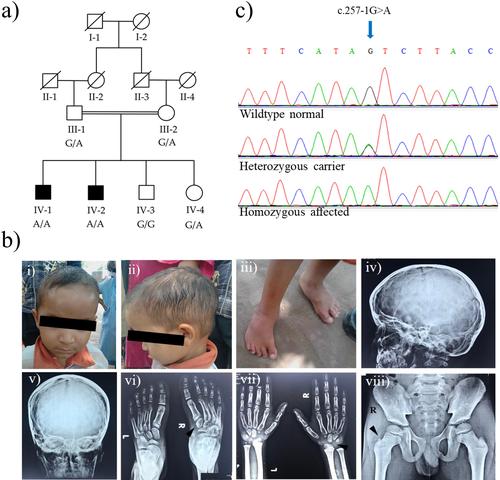 A splice site variant in TCTN3 underlies an atypical form of orofaciodigital syndrome IV