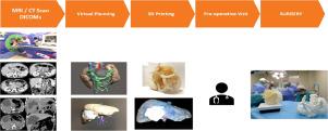 Patient comprehension of oncologic surgical procedures using 3D printed surgical planning prototypes