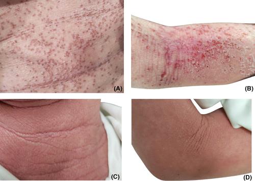 Autosomal recessive hyper-IgE syndrome due to DOCK8 deficiency: An adjunctive role for omalizumab