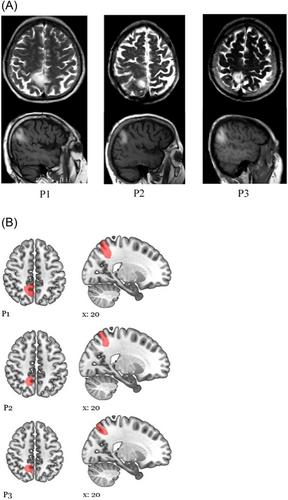 Invisible doppelgänger and body image disorders in right superior parietal lobule stroke, a case series